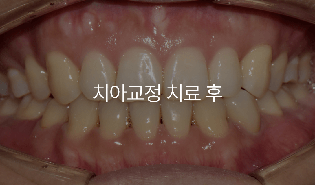 심미보철 치료 사례 3