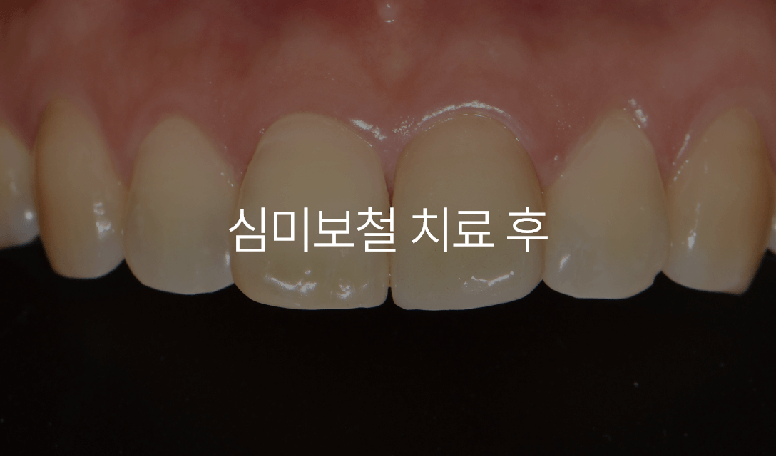치주 치료 사례 4