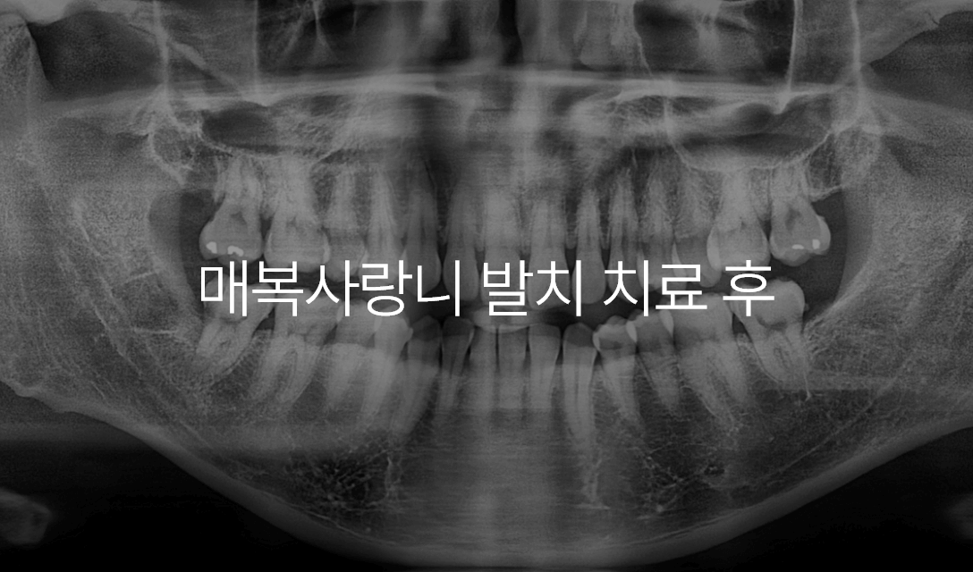치주 치료 사례 4